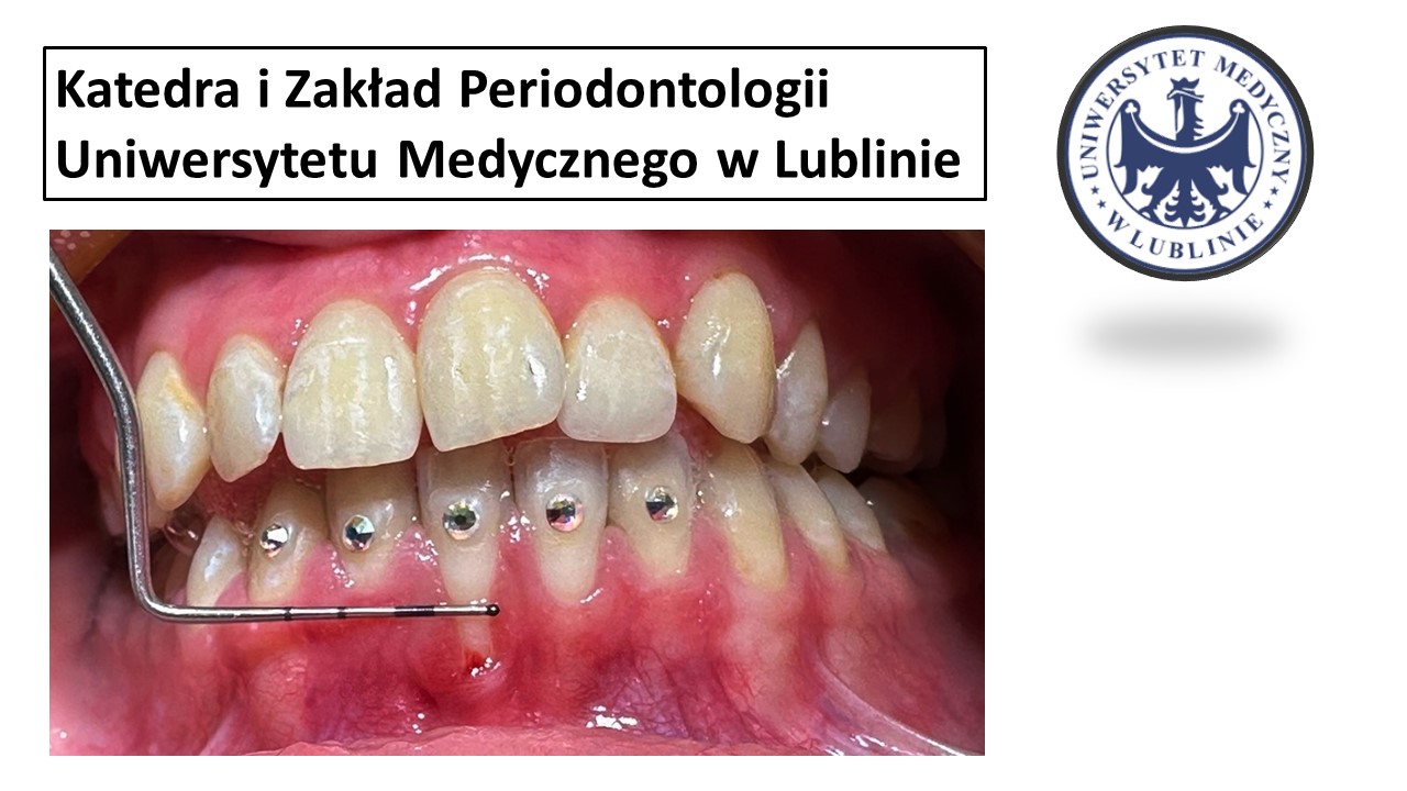 Przychodzi nadwrażliwy ząb do periodontologa…